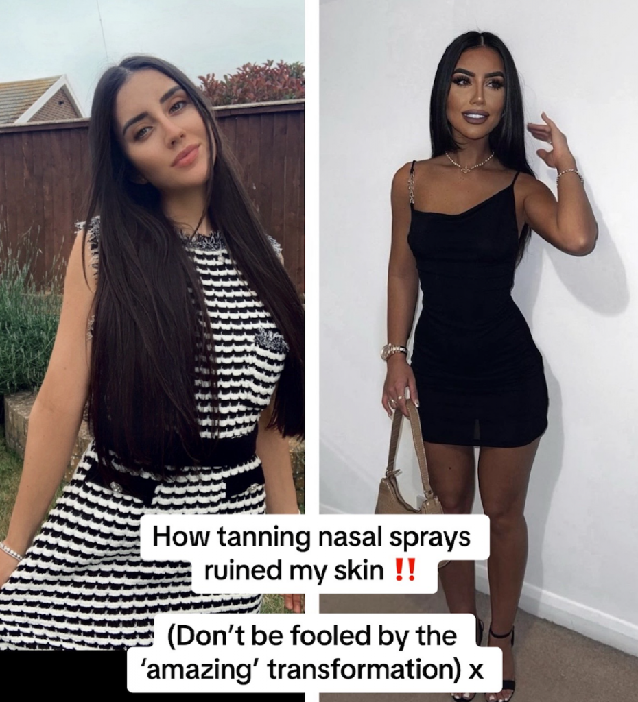Woman Warns Of Tanning Nasal Spray Dangers After Skin Was Ruined 